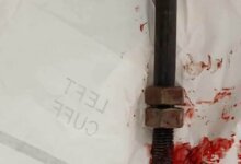 صورة تعبيرية لفريق من أطباء قصر العيني داخل غرفة العمليات يجرون جراحة دقيقة لإنقاذ حياة مريض.